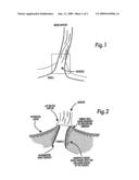 TRANSCUTANEOUS PROSTHESIS diagram and image