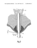 TRANSCUTANEOUS PROSTHESIS diagram and image