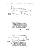 REPLACEMENT BONE TISSUE diagram and image