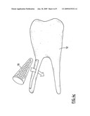 REPLACEMENT BONE TISSUE diagram and image