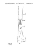 REPLACEMENT BONE TISSUE diagram and image