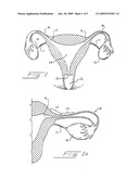 Occlusion of Fallopian Tubes diagram and image