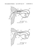 Occlusion of Fallopian Tubes diagram and image