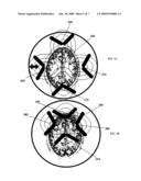 TRANSCRANIAL MAGNET STIMULATION OF DEEP BRAIN TARGETS diagram and image