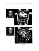 TRANSCRANIAL MAGNET STIMULATION OF DEEP BRAIN TARGETS diagram and image