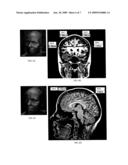 TRANSCRANIAL MAGNET STIMULATION OF DEEP BRAIN TARGETS diagram and image