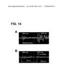 DEVICE AND METHOD FOR IN VIVO FLOW CYTOMETRY USING THE DETECTION OF PHOTOACOUSTIC WAVES diagram and image