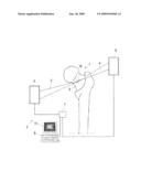 Method and equipment to induce osteogenesis in a bone region of a patient diagram and image