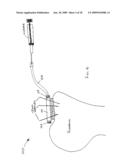 ROTATOR CUFF PATCH DELIVERY DEVICE diagram and image