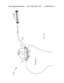 ROTATOR CUFF PATCH DELIVERY DEVICE diagram and image