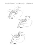 DEVICES AND SYSTEMS FOR MINIMALLY INVASIVE SURGICAL PROCEDURES diagram and image