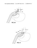 DEVICES AND SYSTEMS FOR MINIMALLY INVASIVE SURGICAL PROCEDURES diagram and image