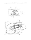 Surgical Drill For Providing Holes At An Angle diagram and image