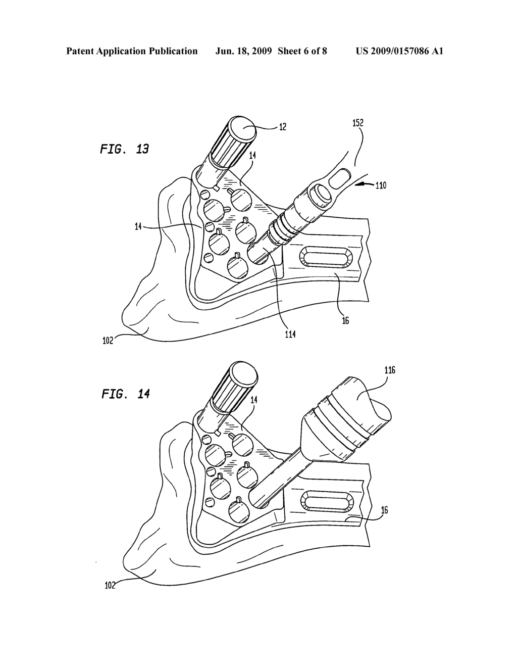 Bone plate instrument and method - diagram, schematic, and image 07