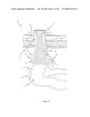 METHOD AND APPARATUS FOR PROVIDING CONTINENCE TO A GASTROINTESTINAL OSTOMY diagram and image