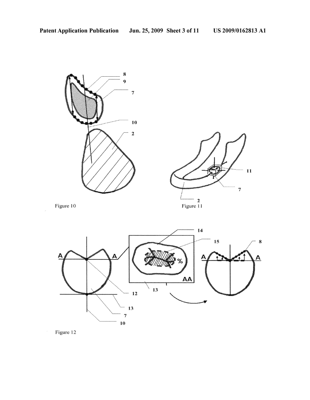 Method for (semi-) automatic dental implant planning - diagram, schematic, and image 04