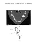 Method for (semi-) automatic dental implant planning diagram and image