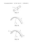 ON-OFF IMPLANT FOR SUPPORTING THE TONGUE diagram and image