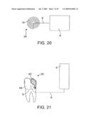 ON-OFF IMPLANT FOR SUPPORTING THE TONGUE diagram and image