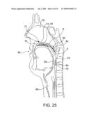 ON-OFF IMPLANT FOR SUPPORTING THE TONGUE diagram and image