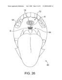 ON-OFF IMPLANT FOR SUPPORTING THE TONGUE diagram and image