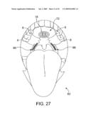 ON-OFF IMPLANT FOR SUPPORTING THE TONGUE diagram and image