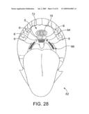 ON-OFF IMPLANT FOR SUPPORTING THE TONGUE diagram and image