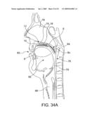 ON-OFF IMPLANT FOR SUPPORTING THE TONGUE diagram and image