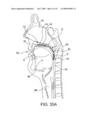 ON-OFF IMPLANT FOR SUPPORTING THE TONGUE diagram and image