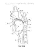 ON-OFF IMPLANT FOR SUPPORTING THE TONGUE diagram and image