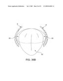 ON-OFF IMPLANT FOR SUPPORTING THE TONGUE diagram and image