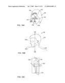 ON-OFF IMPLANT FOR SUPPORTING THE TONGUE diagram and image