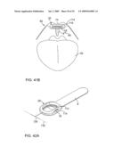 ON-OFF IMPLANT FOR SUPPORTING THE TONGUE diagram and image