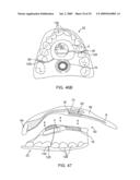 ON-OFF IMPLANT FOR SUPPORTING THE TONGUE diagram and image