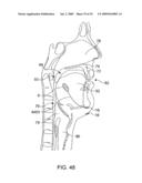 ON-OFF IMPLANT FOR SUPPORTING THE TONGUE diagram and image