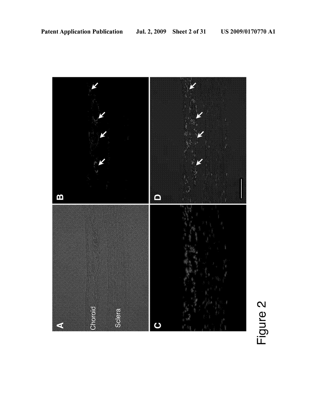 METHODS AND COMPOSITIONS FOR TREATING CONDITIONS ASSOCIATED WITH ANGIOGENESIS USING A VASCULAR ADHESION PROTEIN-1 (VAP 1) INHIBITOR - diagram, schematic, and image 03