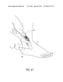 ARTICULAR INJECTION SYSTEM diagram and image