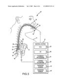 SYSTEMS AND METHODS OF PHOTODYNAMIC-BASED CARDIAC ABLATION VIA THE ESOPHAGUS diagram and image