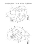 Surgical System and Procedure for Treatment of Medically Refractory Atrial Fibrillation diagram and image