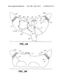 Surgical System and Procedure for Treatment of Medically Refractory Atrial Fibrillation diagram and image