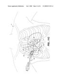 Surgical System and Procedure for Treatment of Medically Refractory Atrial Fibrillation diagram and image