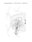 Surgical System and Procedure for Treatment of Medically Refractory Atrial Fibrillation diagram and image