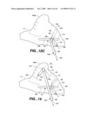 Surgical System and Procedure for Treatment of Medically Refractory Atrial Fibrillation diagram and image