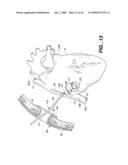 Surgical System and Procedure for Treatment of Medically Refractory Atrial Fibrillation diagram and image