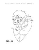 Surgical System and Procedure for Treatment of Medically Refractory Atrial Fibrillation diagram and image