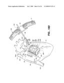 Surgical System and Procedure for Treatment of Medically Refractory Atrial Fibrillation diagram and image