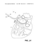 Surgical System and Procedure for Treatment of Medically Refractory Atrial Fibrillation diagram and image