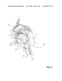 PARTIALLY ERODABLE SYSTEMS FOR TREATMENT OF OBSTRUCTIVE SLEEP APNEA diagram and image