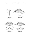 Shunt Device for Glaucoma Treatment diagram and image