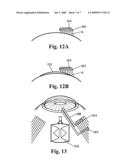 Shunt Device for Glaucoma Treatment diagram and image